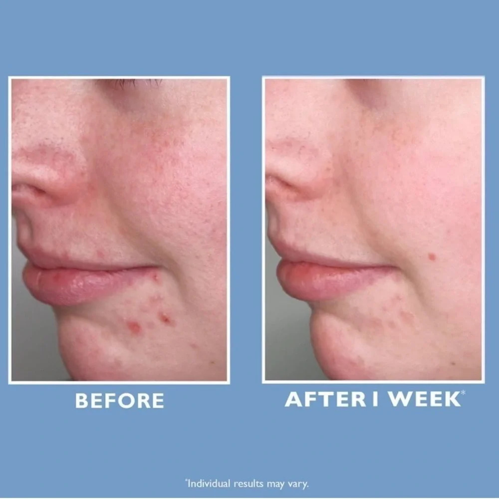 ONLY 1! Peter Thomas Roth ProStrength 10% PHA Exfoliating Clarifying Liquid - Picture 3 of 7